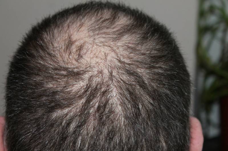 Alopecia Androgenetica Come Curarla E Contrastarla Kro Mag Ine